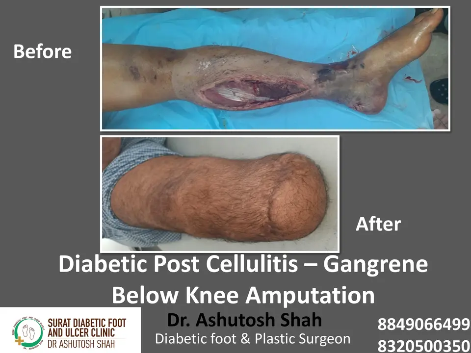 Diabetic Foot  PPT sunita.pptx-8.webp